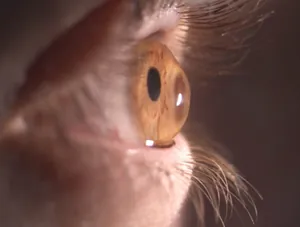 Sklerallinse auf Auge